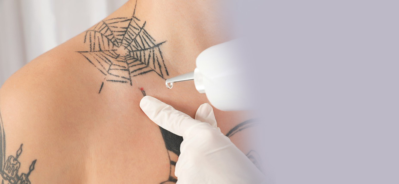 Art Tattoo Removal 